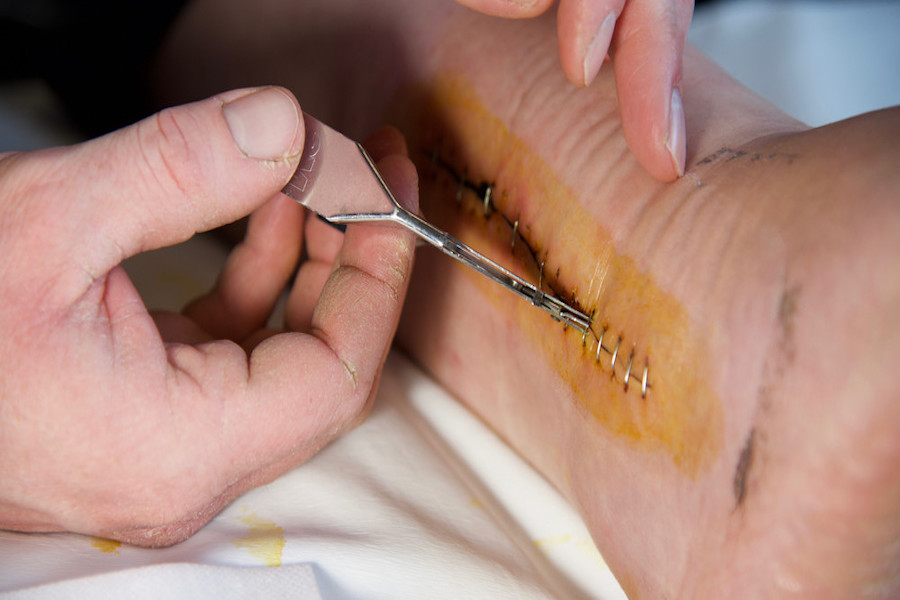 ablation-fil-agrafe-infirmier-thionville